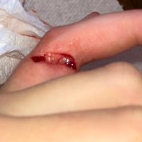 Finger Injury (Before)