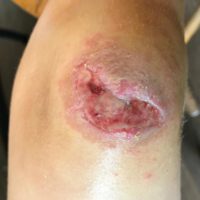 Knee Injury (Before)